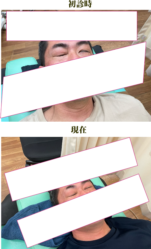 顔面神経麻痺症例・改善例