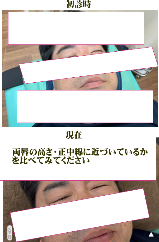 ベル麻痺改善例・症例