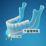 下歯槽神経麻痺の回復過程