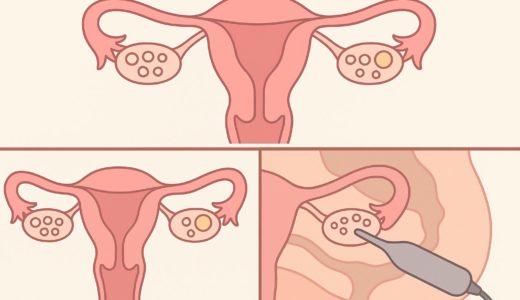 卵巣の左右で卵子の質は変わる？いつも片方からしか採卵できない